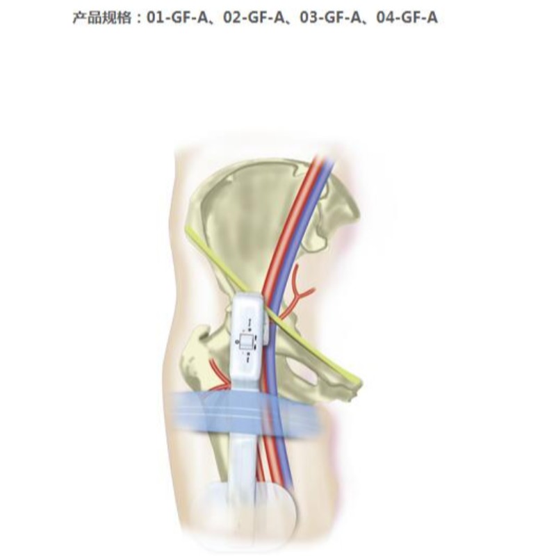 Goldfinger Electronic Femoral Hemostasis Compression Device